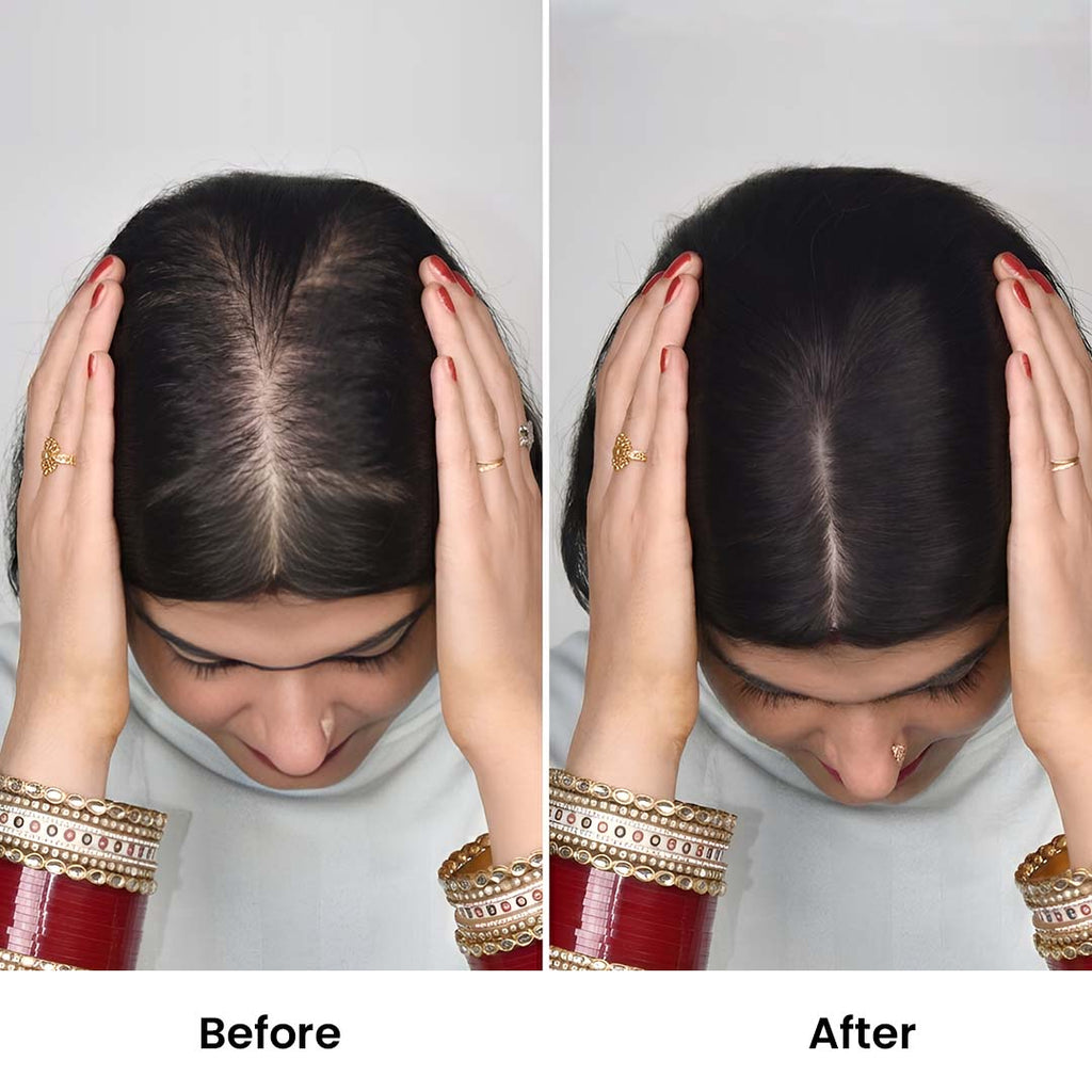 Silk Base Hair Topper – Large Crown Coverage for Severe Hair Loss, 4.5×6 Base