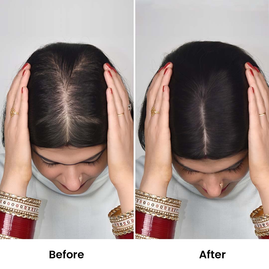 Silk Base Hair Topper – Large Crown Coverage for Severe Hair Loss, 4.5×6 Base