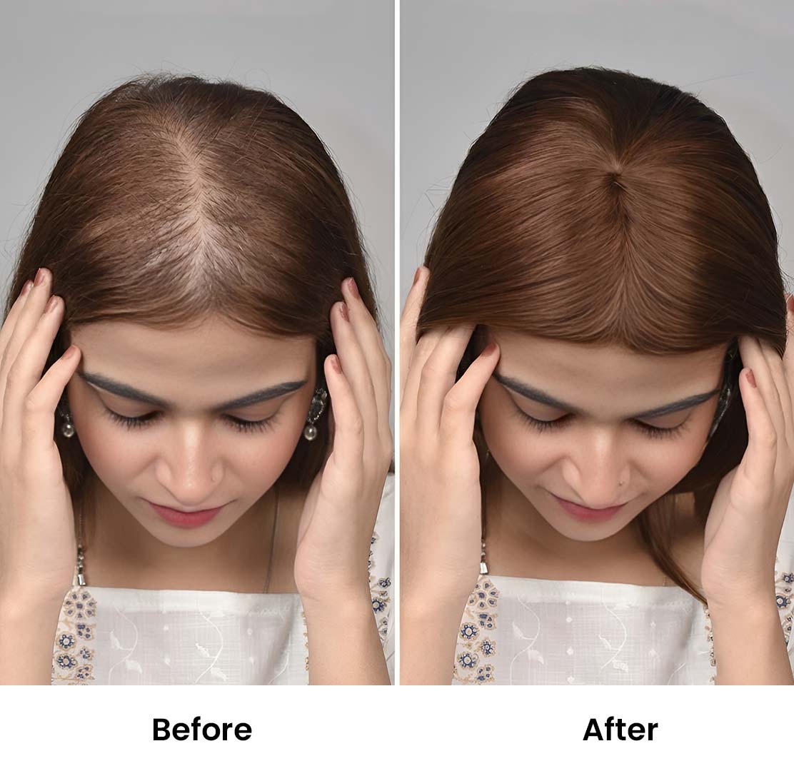 Lace Hair Topper – 14 Inch, Crown & Part Line Coverage for Thinning Hair