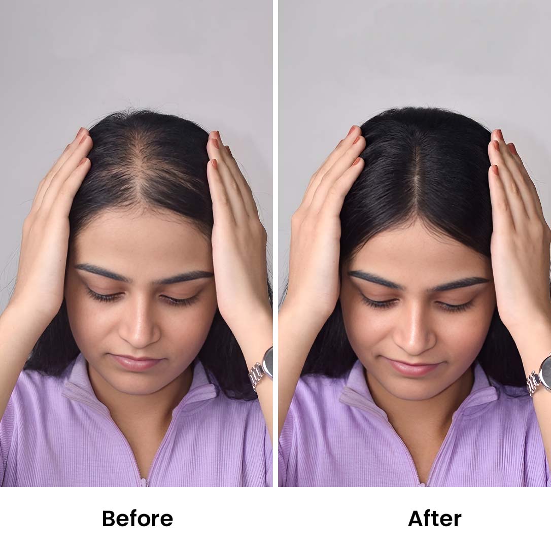 Lace Hair Topper – 16 Inch, Crown & Part Line Coverage for Thinning Hair